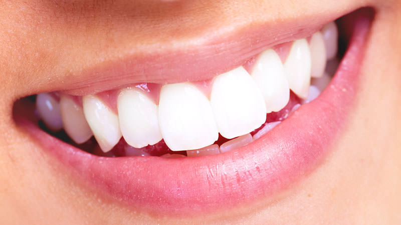 Cerec Veneers und Kronen