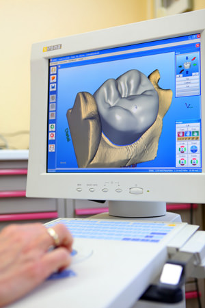 Cerec 3D